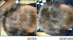 Tratamiento  alopecia Danien 3
