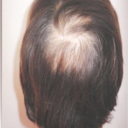 alopecia coronilla en mujer